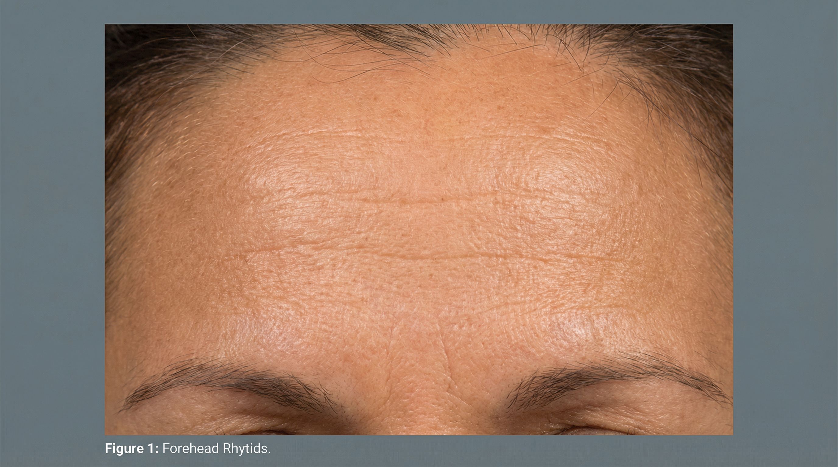 Close-up showing forehead lines and wrinkles